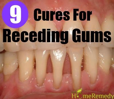 9 Natural Cures For Receding Gums