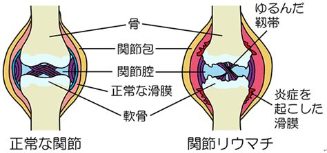 関節リウマチ｜膠原病・リウマチ内科｜順天堂医院