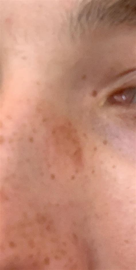 Skin Concerns Red Marks Where My Glasses Hit My Nose R