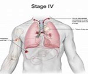 Stage 4 breast cancer means that the cancer has spread to other areas of the body, such as the although stage 4 breast cancer is not curable, it is usually treatable and current advances in research. Prostate Cancer - Bethzatha - ቤተዛታ
