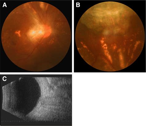 Fundus Photograph And B Scan Ultrasound Of The Right Eye 2 Months