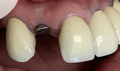 Dental Implants Downey Ca Permanent Tooth Replacement