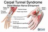 Pictures of What Doctor Treats Carpal Tunnel