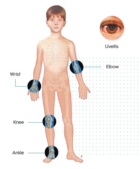 Juvenile Idiopathic Arthritis Medinformer