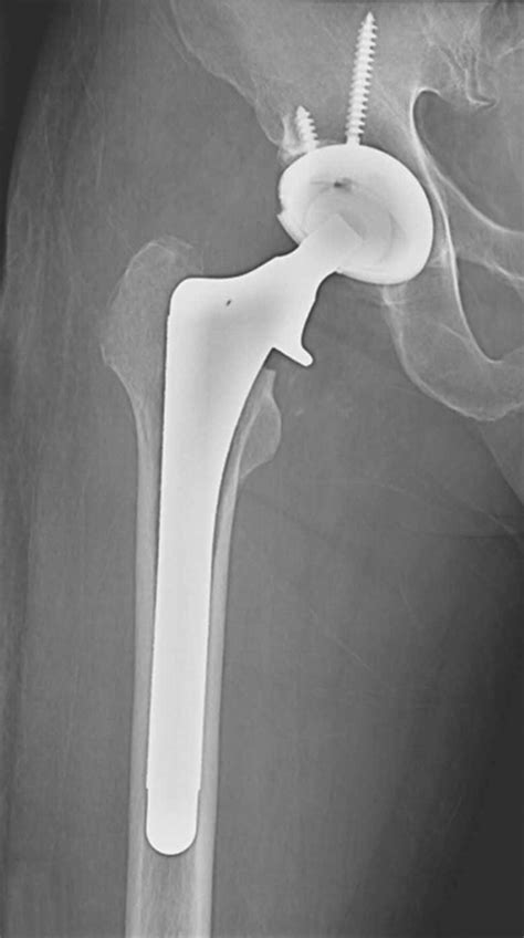 Cementless Revision For Infected Total Hip Replacements Bone And Joint