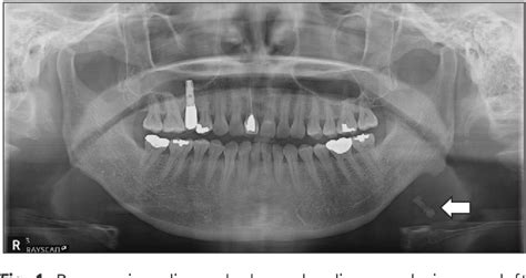 Figure 1 From Toothache Caused By Sialolithiasis Of The Submandibular