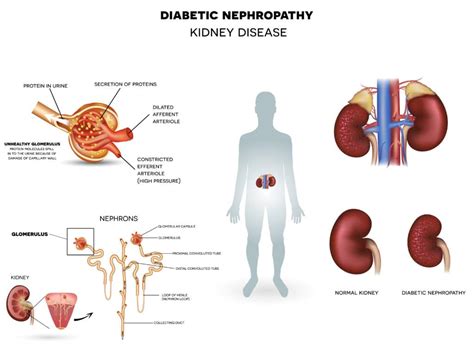 8 Important Complications Of Diabetes You Need To Know Medic Drive