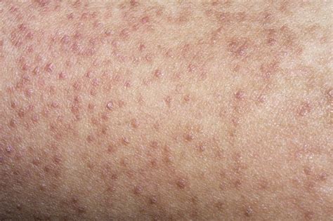 Itchy Skin Bumps On Arms