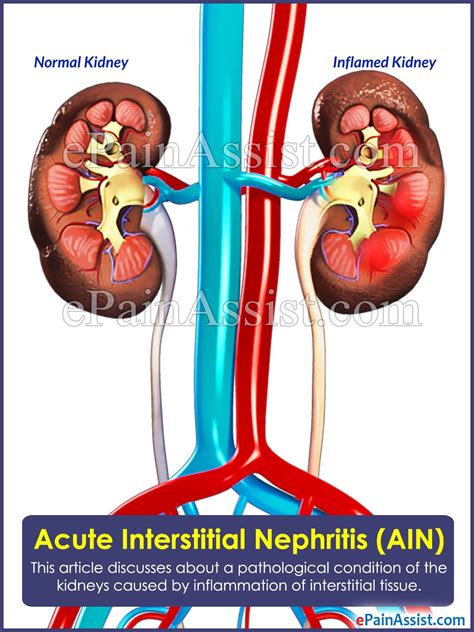Acute Interstitial Nephritis Aincausesrisk Factorssymptoms