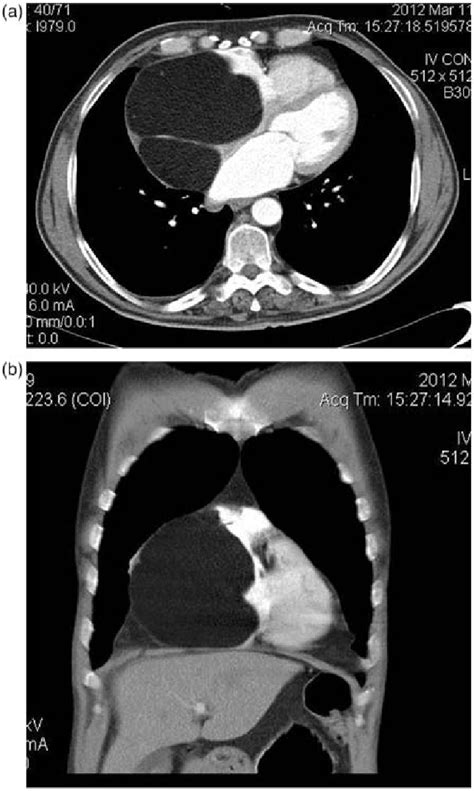 A B Chest Computed Tomography Images With Contrast Showing A 95 Â