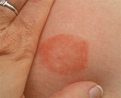 Spider Bite Pictures Symptoms And Treatments Youmemindbody