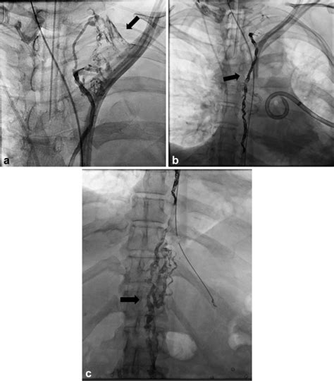 Intranodal Lymphangiography With Thoracic Duct Embolization For