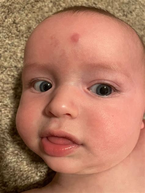 Bump On Forehead Babycenter