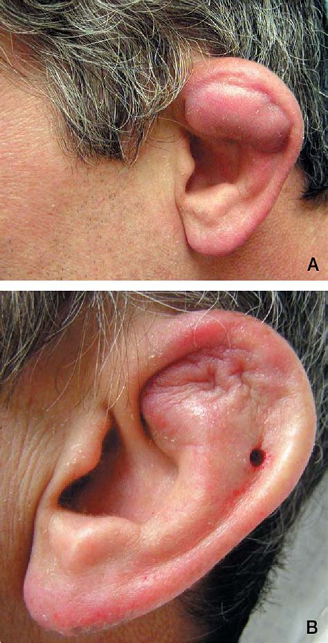 Figure 1 From Successful Treatment Of Auricular Pseudocyst Using A