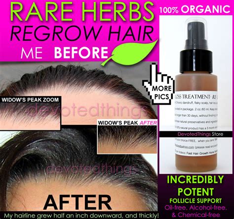 It seems like this technology is ripe for helping speed up the development of hair loss treatments. ORGANIC HAIR REGROWTH TREATMENT MEN & WOMEN HAIR LOSS ...