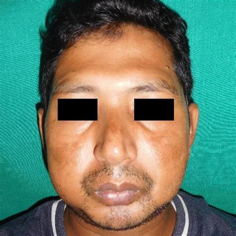 Facial Asymmetry Due To Bilateral Swelling Of Lower Jaw More Prominent