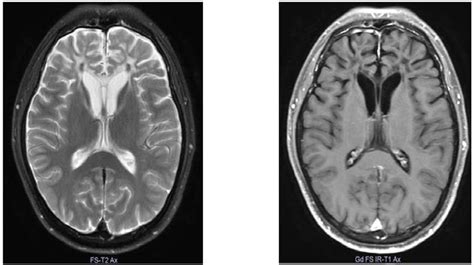 Head Mri Of T2wi Mage A There Were Atrophic Changes In Both Frontal