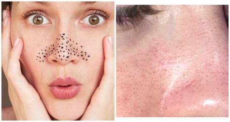 8 Ways To Remove Dark Patches From Nose And Cheeks