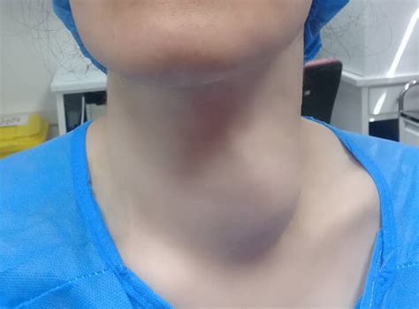 آیا لنف نود خطرناک است؟ غدد لنفاوی گردن کجاست ؟ کدام توده در گردن