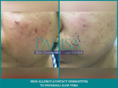 Skin Allergy Rash Cream Update Berita Olahraga Dalam Luar