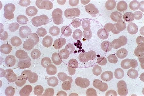 Free Picture Micrograph Mature Plasmodium Malariae Schizont