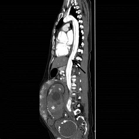 Acute Type A Aortic Dissection In A 37 Week Pregnant Patient An