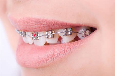 Orthodontics Brackets Braces Sbis