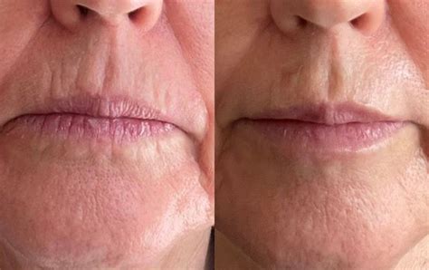 Non Surgical Face And Lip Line Treatment — Winchester The Secret