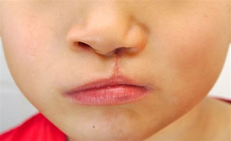 Cleft Lip And Cleft Palate Ent Health