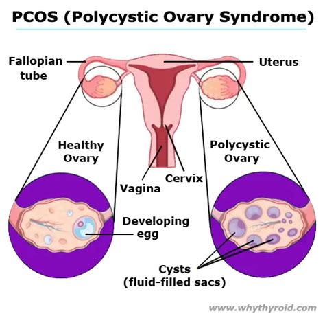 Polycystic Ovary Syndrome Pcos Symptoms Treatment Why Thyroid