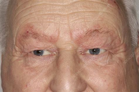 Seborrhoeic Dermatitis Around Eyes Stock Image C0042405 Science