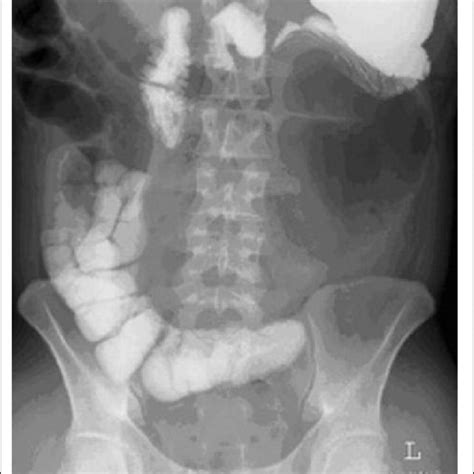 Dilated Small Bowel Loops On The Plain Abdominal X Ray Download