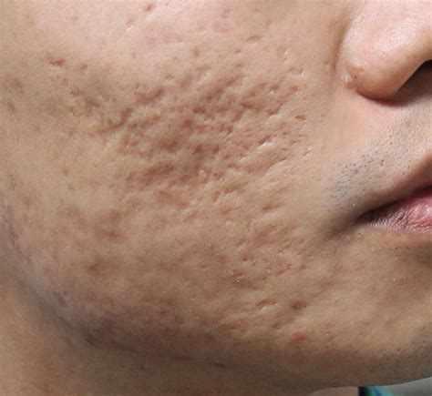 Skintherapy Ask The Esthetician More On Acne Scar Treatments And How
