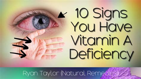 10 Common Signs Of Vitamin A Deficiency Youtube