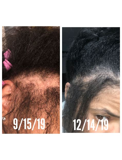 After all the mistakes have been and gone you're still standing here, standing strong and i forgive all the i don't care who does her hair or what clothes she wears i don't care if it's ysl. My client had some hair loss after having her baby due to ...