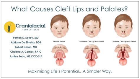 Cleft Lips And Palates Dell Childrens Craniofacial Team Of Texas
