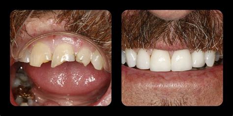 My tooth that's just had root canal had a filling in it for years and it did just fine. Porcelain Crowns | Porcelain crowns, Root canal treatment ...