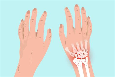 Arthritis In The Wrist Symptoms Types Of Wrist Arthritis Treatments