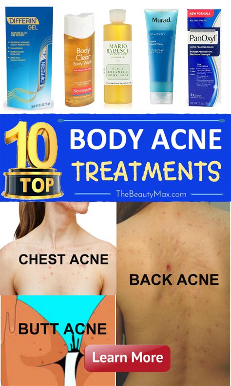 Pin By Acne Go Away On Body Acne Treatment Body Acne Treatment Body Acne Acne Treatment