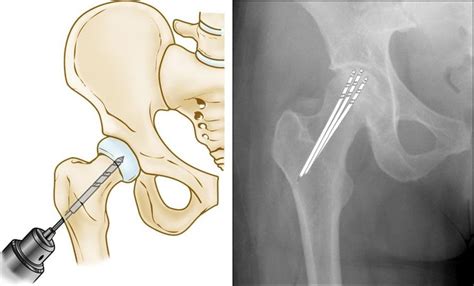 Avascular Necrosis AVN Of The Femoral Head Hip Osteonecrosis Frisco TX Orthopedic Surgeon