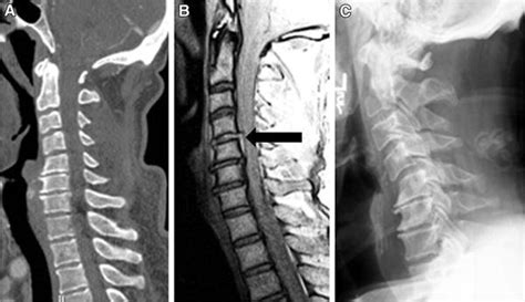 A Sagittal Reconstruction Of Cervical Spine Shortly After Motor Vehicle