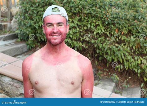 Man With Pale Complexion Getting Sunburnt Stock Photo Image Of Funny