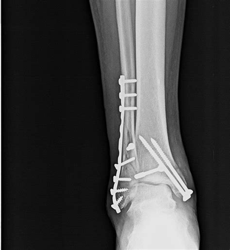Ankle Fractures And Dislocations Injuries Bone And Spine Ankle