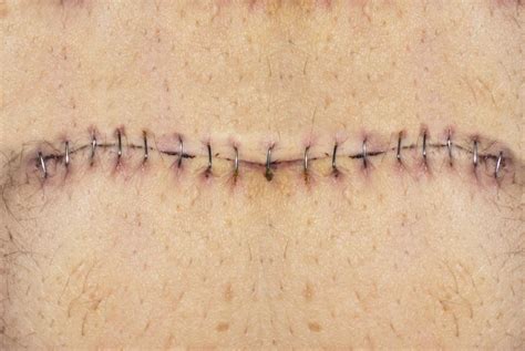 How Do I Care For A Hysterectomy Incision With Pictures