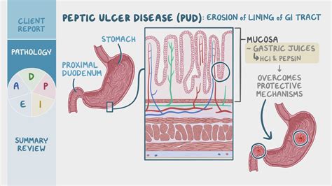 Peptic Ulcer Disease Pud Nursing Process Adpie Osmosis