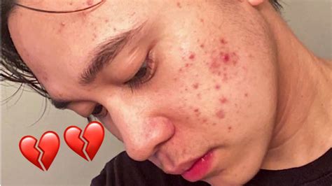 My Acne Breakout Youtube