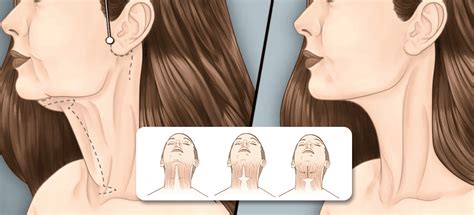 10 Tips On How To Get A Wider Jaw Mewing Coach