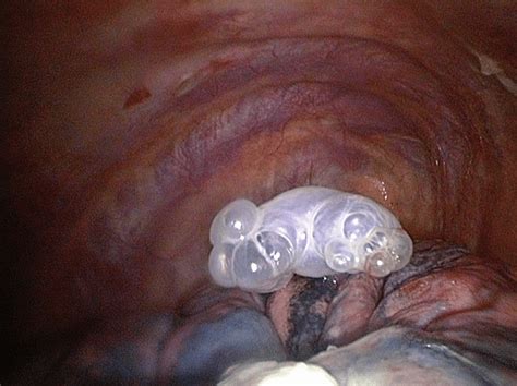 This air pushes on the outside of your lung and makes it collapse. Single apical bulla, a common cause of primary spontaneous ...