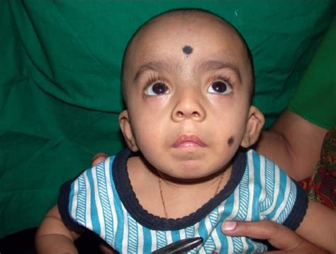 Velocardiofacial Digeorge Syndrome