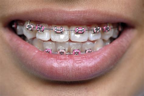 Coloured Braces Dr Aly Kanani Bc Orthodontist